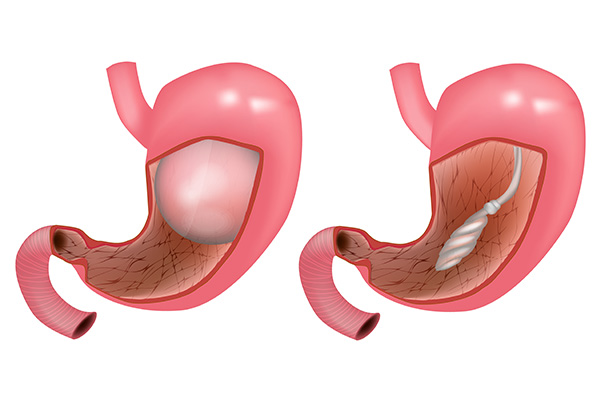 ballon-intra-gastrique